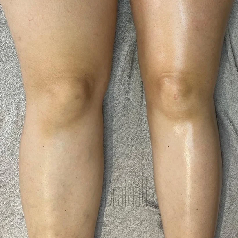 Drainalia Drainage Lymphatique Montpellier Realisations 1